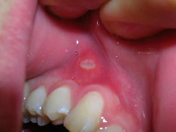 Close-up view of an individual's lower front teeth, showing signs of gum recession and other dental issues.