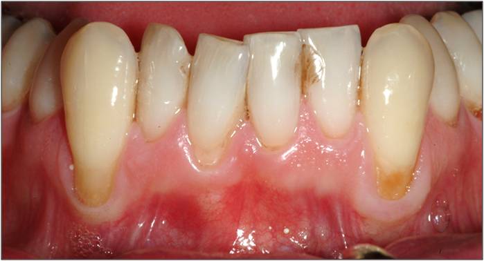 Close-up of a person's lower front teeth showing signs of gum recession and dental issues.