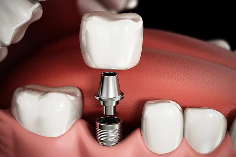 3D rendering representing the structure of dental implant procedure 3D rendering representing the structure of dental implant procedure.