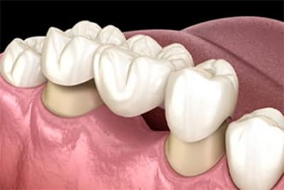 Dental Prosthetics Dental Prosthetics