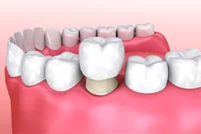 porcelain-crowns porcelain-crowns image